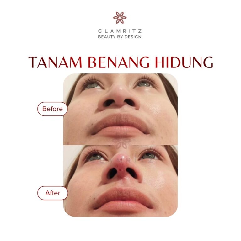 Dokumentasi before dan after treatment Glamritz 15