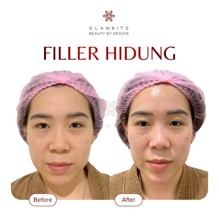 Dokumentasi before dan after treatment Glamritz 10