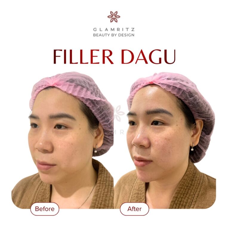 Dokumentasi before dan after treatment Glamritz 9