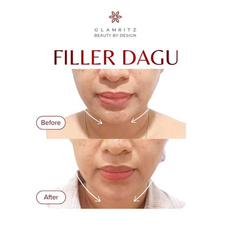 Dokumentasi before dan after treatment Glamritz 7