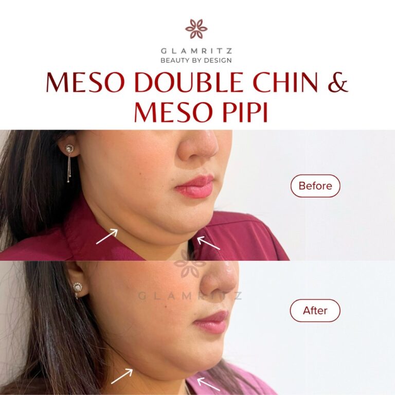Dokumentasi before dan after treatment Glamritz 17