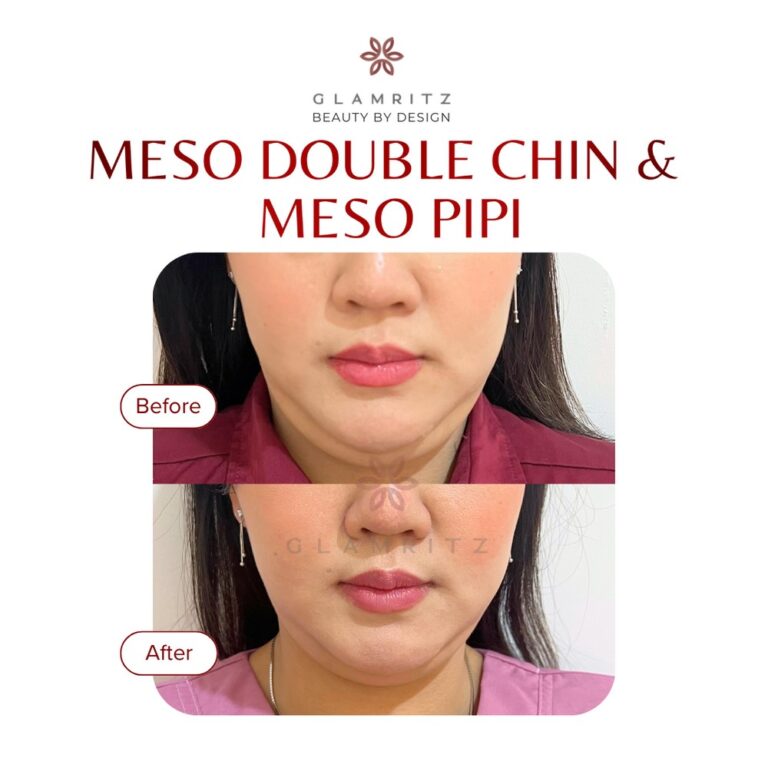 Dokumentasi before dan after treatment Glamritz 18