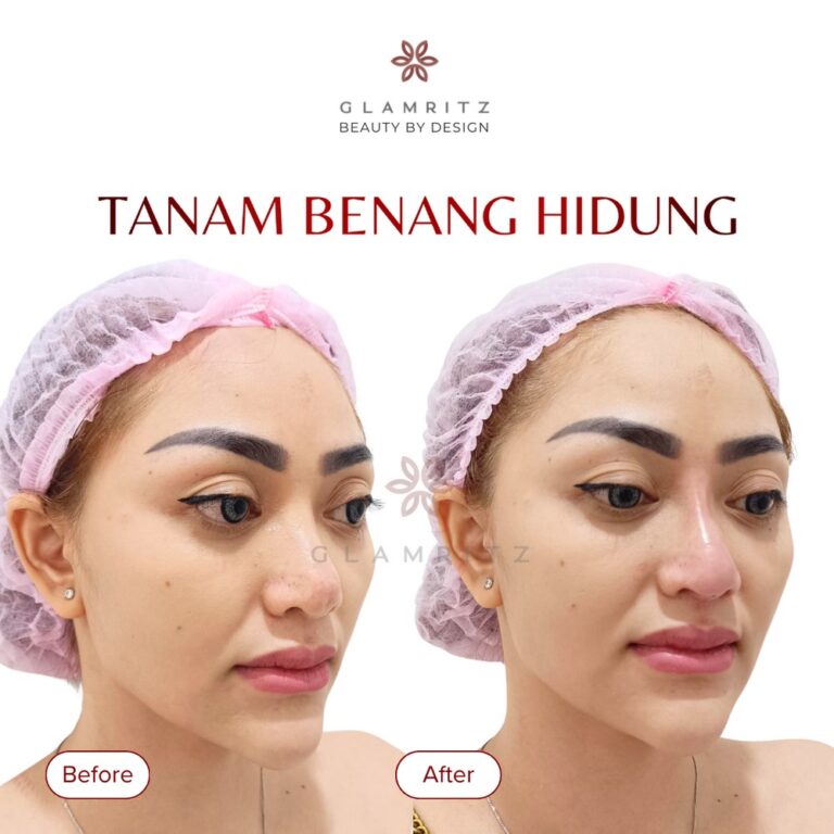 Dokumentasi before dan after treatment Glamritz 14