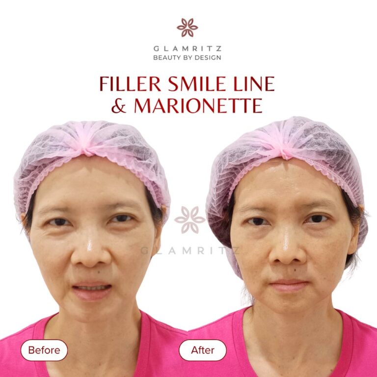 Dokumentasi before dan after treatment Glamritz 2