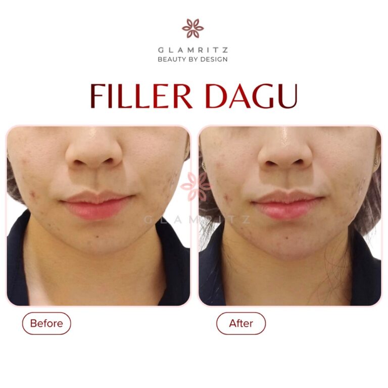 Dokumentasi before dan after treatment Glamritz 8