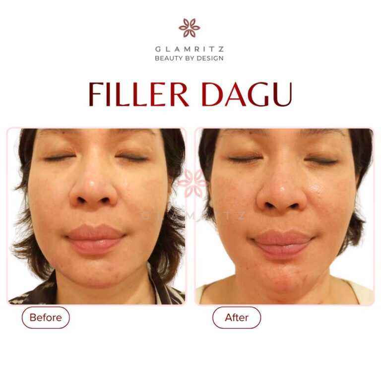 Dokumentasi before dan after treatment Glamritz 5