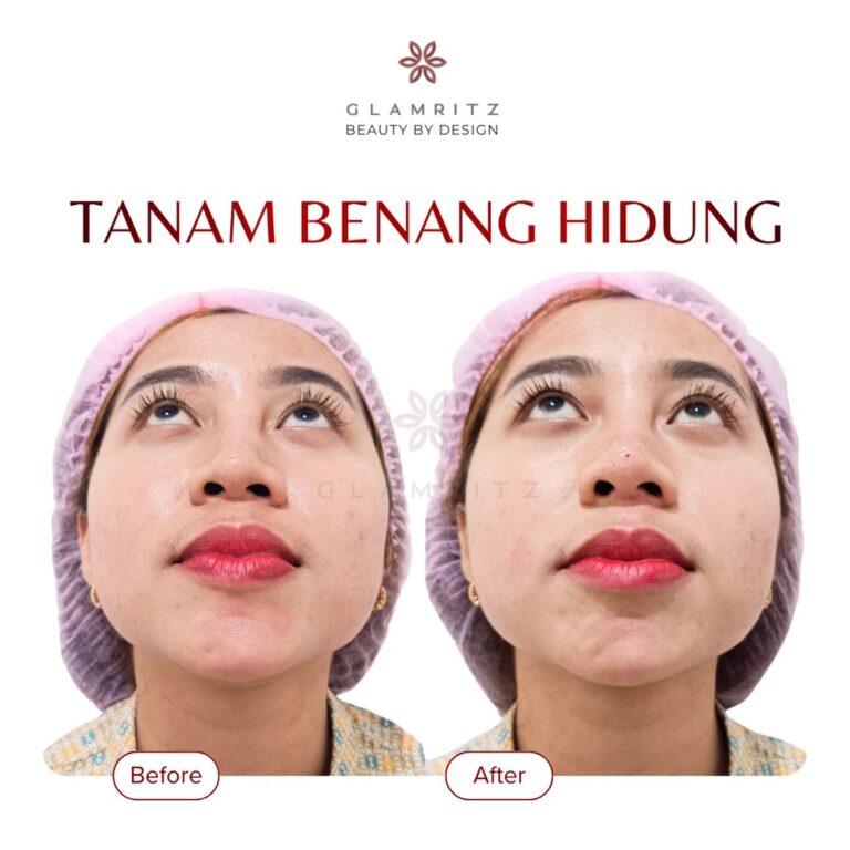 Dokumentasi before dan after treatment Glamritz 12