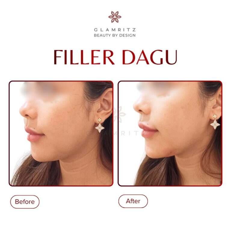 Dokumentasi before dan after treatment Glamritz 4