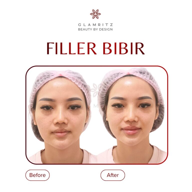 Dokumentasi before dan after treatment Glamritz 1