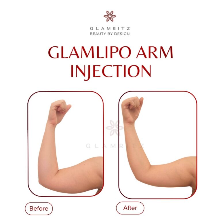 Dokumentasi before dan after treatment Glamritz 16