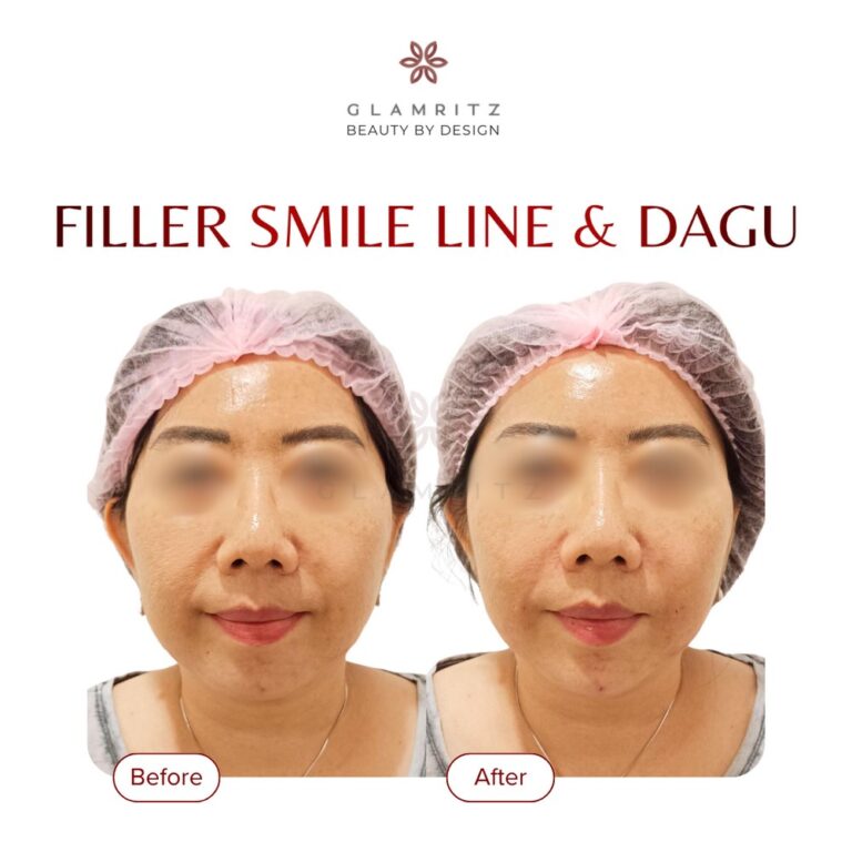 Dokumentasi before dan after treatment Glamritz 3