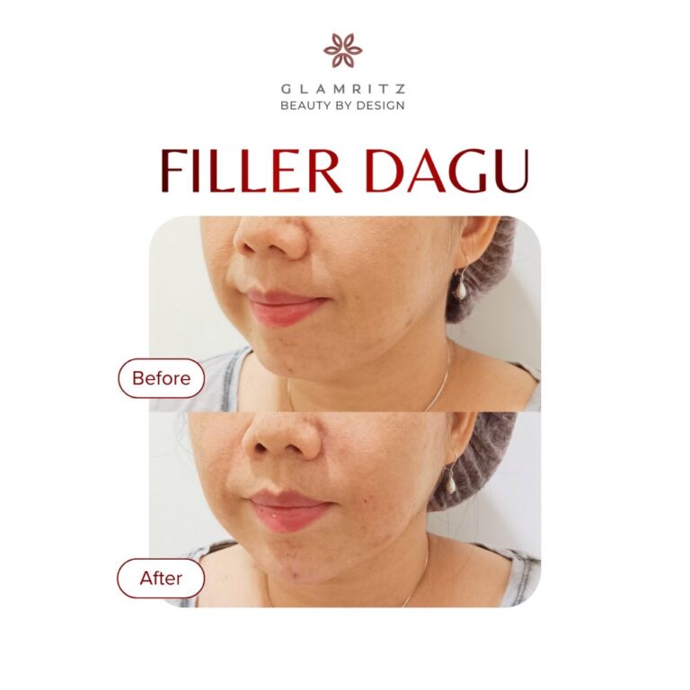 Dokumentasi before dan after treatment Glamritz 6