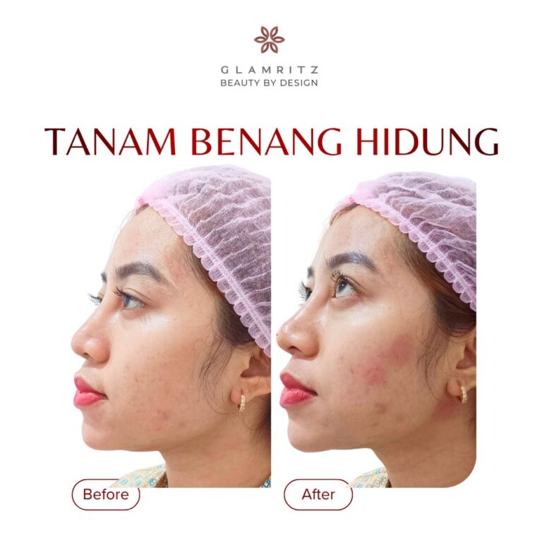 Dokumentasi before dan after treatment Glamritz 13